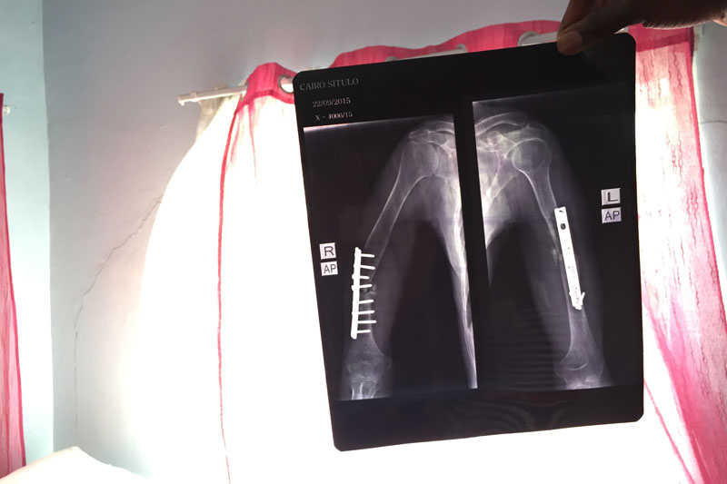 Mr. Situlo's x-ray, showing his orthopedic surgery.