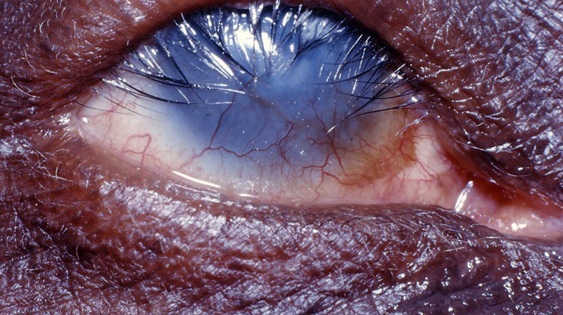 An example of an infected eye with eyelashes turning inward. This scratching of the cornea can lead to blindness.